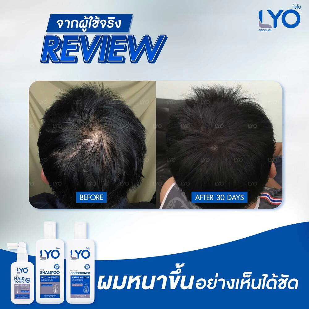 ยาสระผมไลโอ รีวิว lyo hair tonic รีวิว