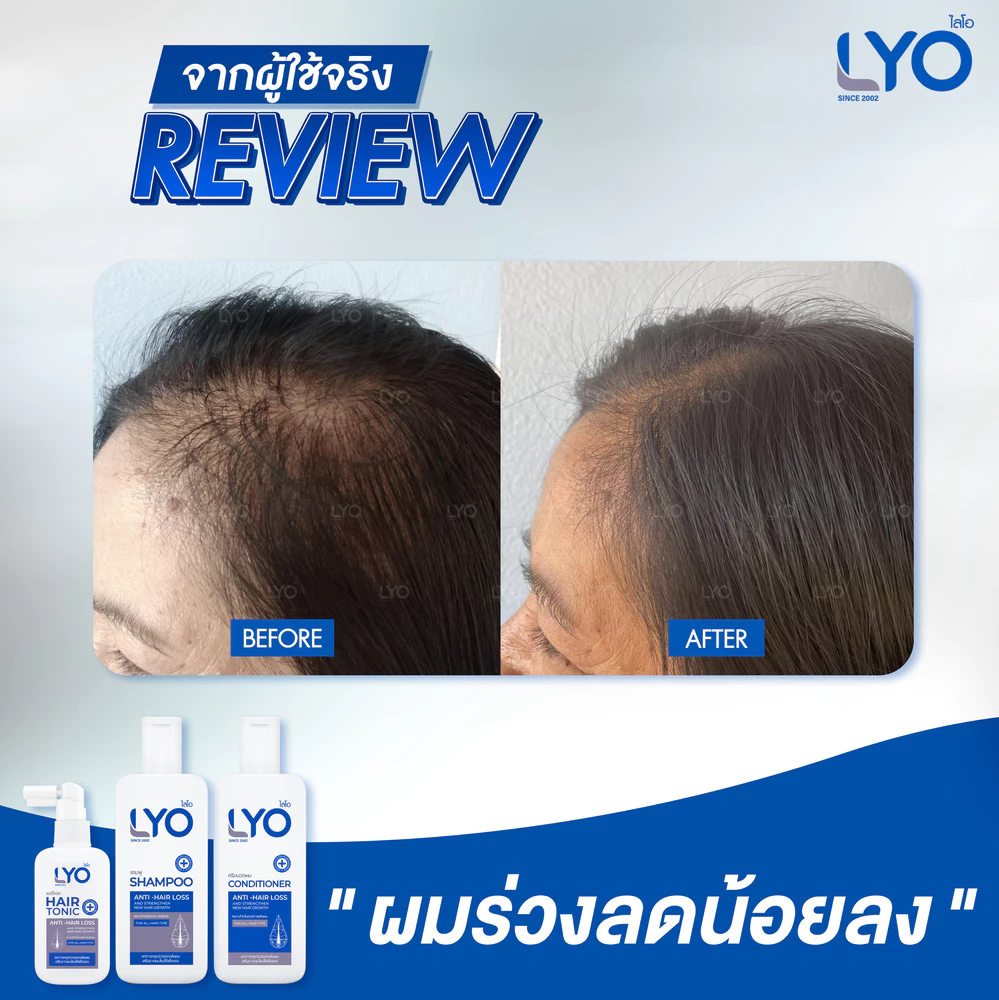 ยาปลูกผม lyo ดีไหม lyo ขายที่ไหน รีวิว